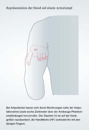 Phantomschmerzen nach Bein-Amputation: ZI Mannheim