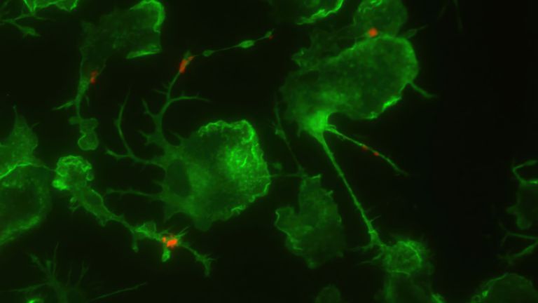 Gehirnzellen mit Ablagerungen von Amyloid-beta-Proteinen (rot), die charakteristisch für die Alzheimer-Krankheit sind